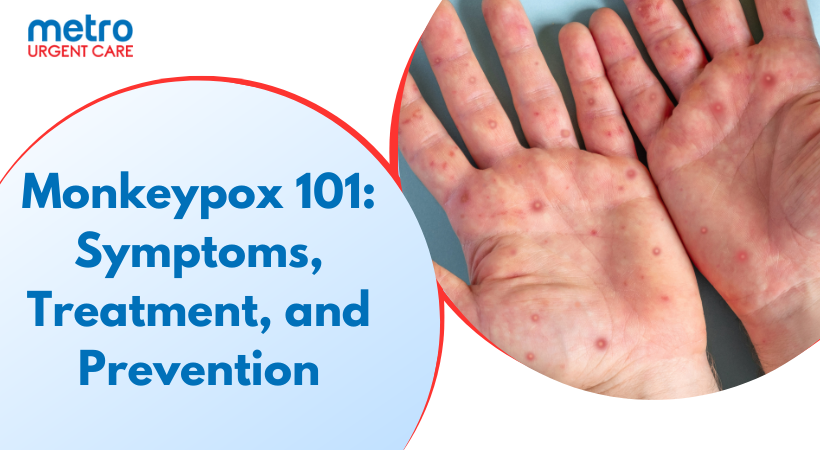 Monkeypox 101: Symptoms, Treatment, and Prevention
